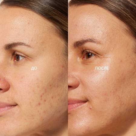 проблемная из-за гормонального сбоя