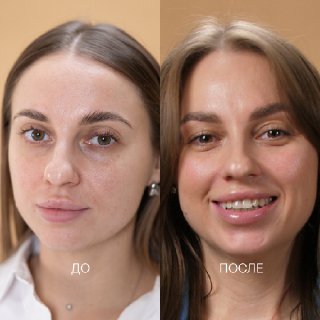 сухая, чувствительная кожа, пигментация