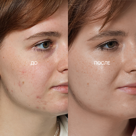 НЕподростковое акне