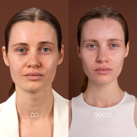 расширенные поры, мелкие морщинки, рубцы постакне, высыпания на лице, купероз