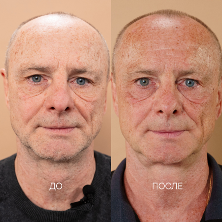 сухость, шелушение, краснота, снижение тургора, тусклый цвет лица, мышечные зажимы