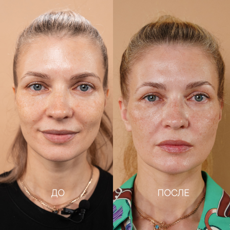 сухая обезвоженная кожа с высоким уровнем десквамации