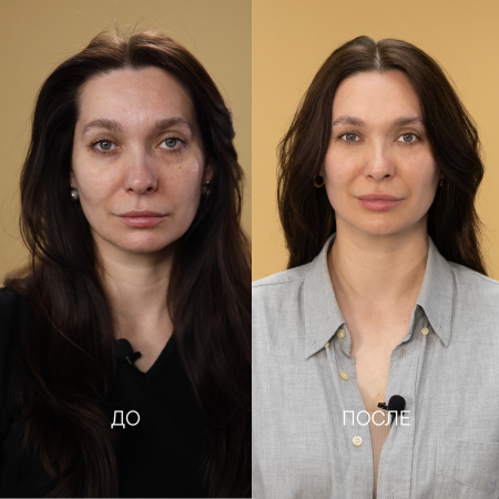 проблемы с кожей из-за нарушения барьерной функции и последствий акне