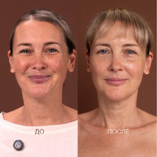 расширенные поры, мелкие морщинки, высыпания на лице, купероз