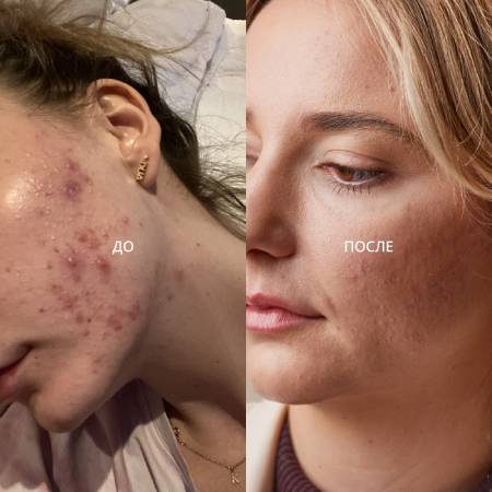 прыщи & воспалительные элементы