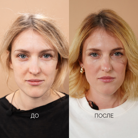 сухость, пигментация,  повышенная чувствительность 