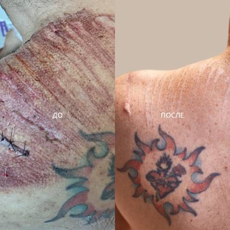 шрамы после ДТП