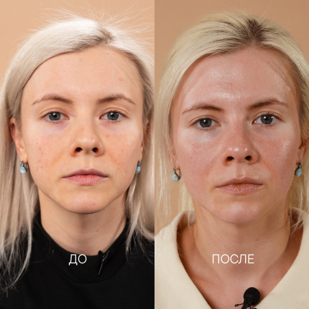 сухая, гиперчувствительная, обезвоженная кожа с высыпаниями и шелушением